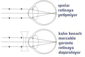 miyop göz kusuru